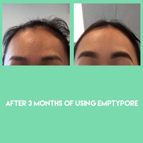 Before & after using Sebaceous Filament Extraction routine