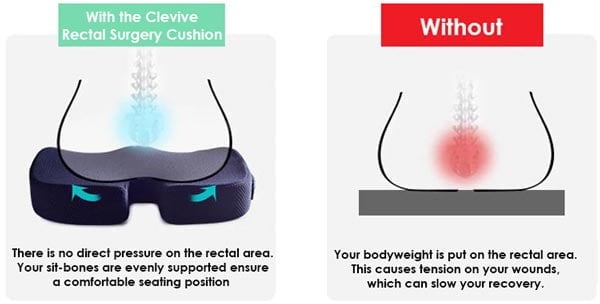 Clevive™ Hemorrhoid Cushion – Clevive