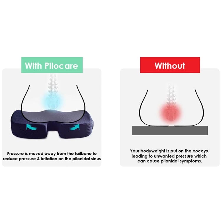 Pilocare™ Pilonidal Sinus Cushion – Clevive