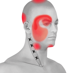 Cervicogenic Headaches